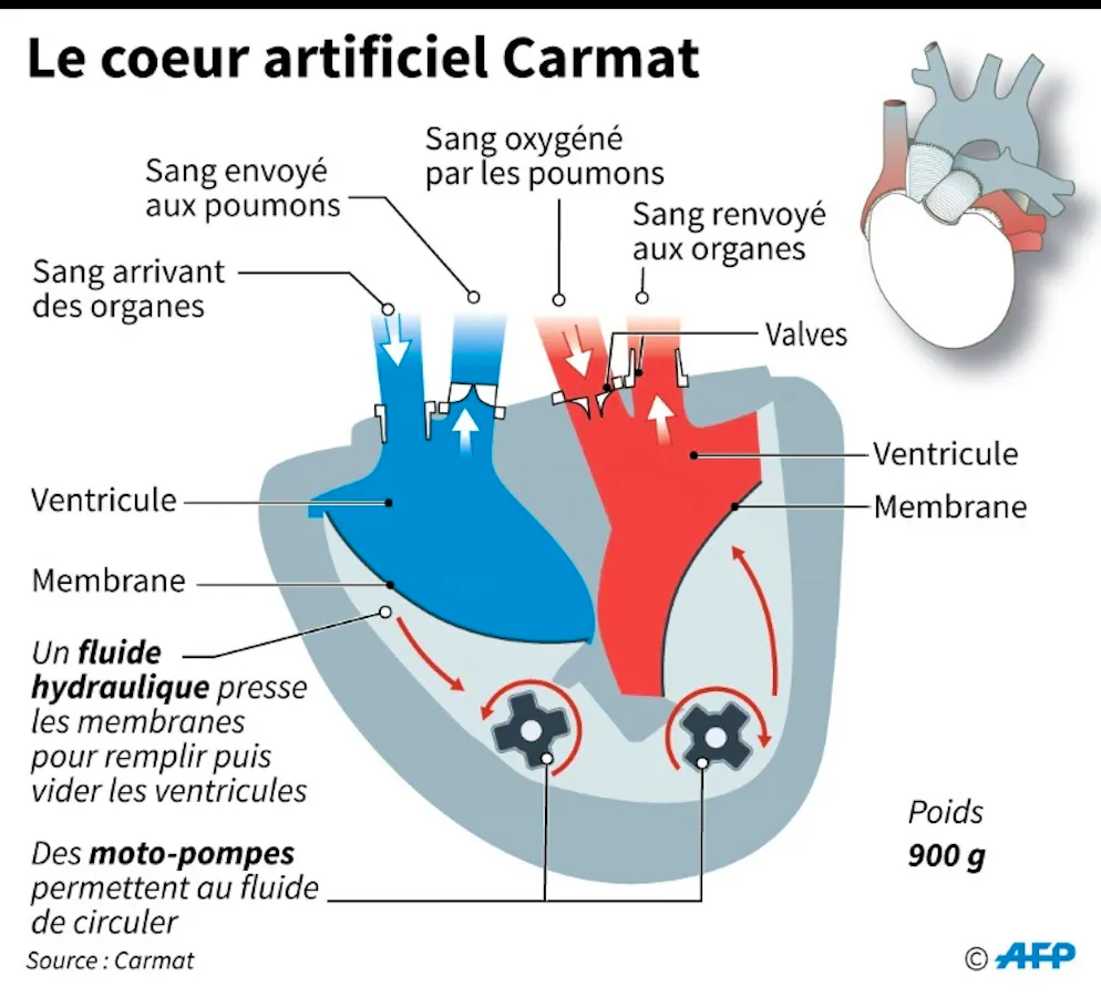 Coupe du coeur artificiel total de la société française Carmat