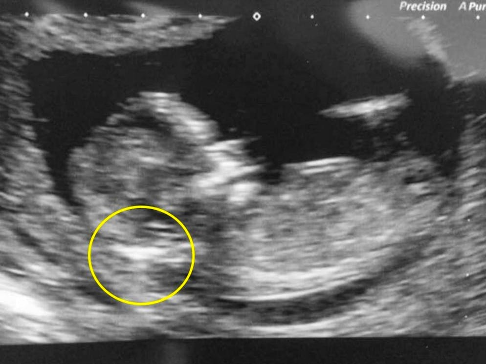 Una donna rifiuta di abortire malgrado il consiglio dei medici. I medici hanno scoperto un accumulo di liquido a livello del collo del feto e ne hanno dedotto una quasi certa sindrome di Down: un'anomalia genetica che causa un ritardo mentale e delle malformazioni fisiche.