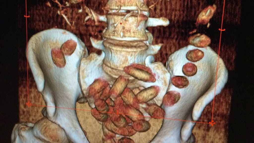 Guanziroli am Gericht. Der Körper als Drogen-Versteck: So gelangt Kokain in die Schweiz