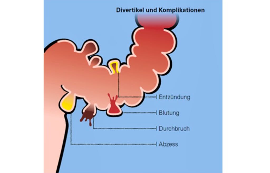 Volkskrankheit Divertikel: Wenn der Darm Ärger macht