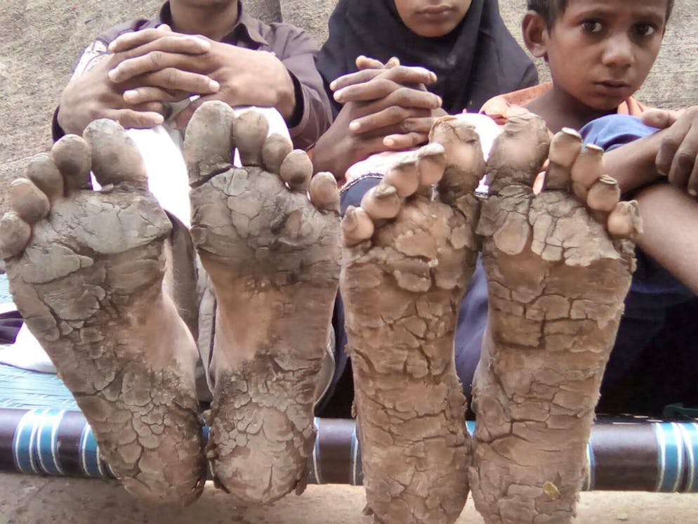 Malattia che pietrifica la pelle. La pianta dei piedi di questi bambini è terrificante: sono infatti affetti da una rarissima malattia ereditaria chiamata «ittiosi epidermolitica».