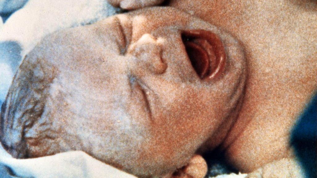 40 Jahre künstliche Befruchtung. Das Mädchen aus dem Reagenzglas