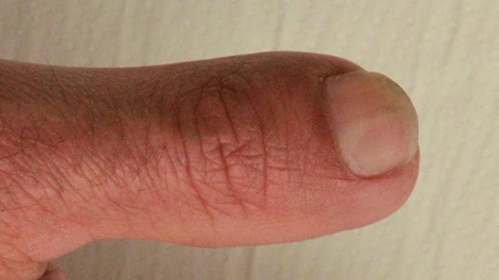 Fingerkuppe abgeschnitten wie lange krank