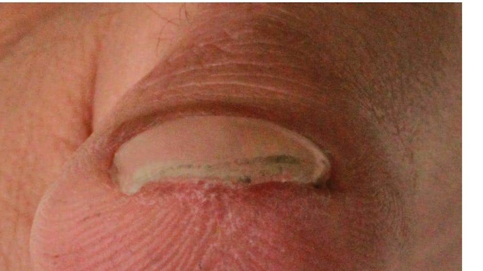 Un doigt amputé repousse tout seul. Dès que la blessure est entièrement guérie et que l'extrémité du doigt s'est régénérée, le film peut être retiré. Enfin, l'ongle commencera à repousser.