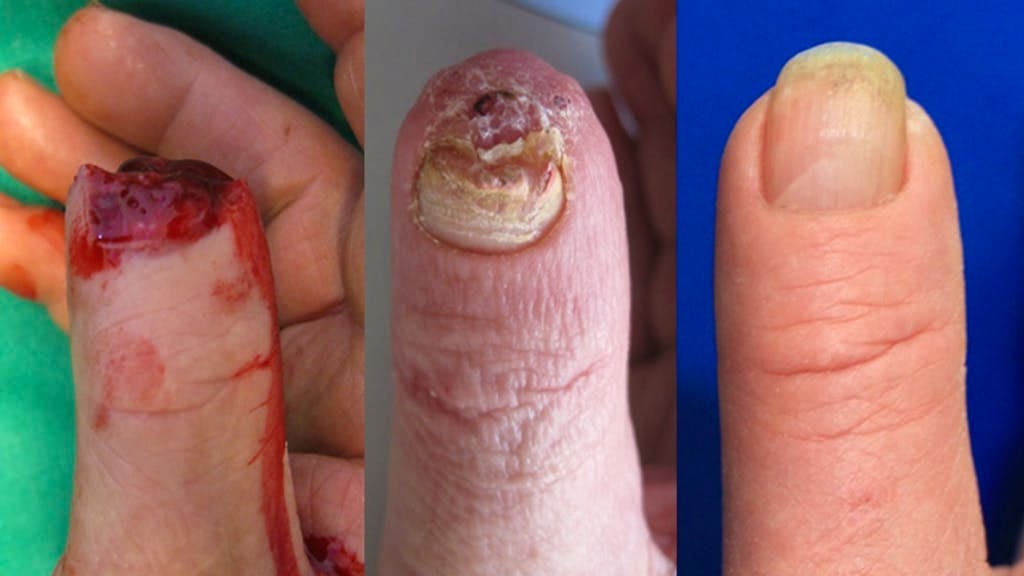 Voici comment repousse une extrémité de doigt