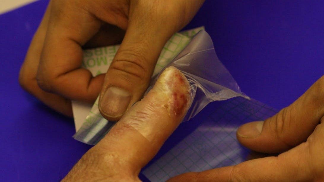 Heilung fingerkuppe abgetrennt Wundheilung frisches