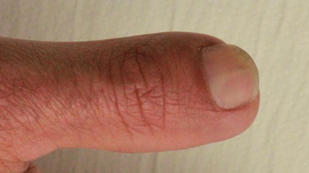 Polpastrello amputato che ricresce. A parte il cambio settimanale della fasciatura, il dito resta avvolto nella pellicola durante tutta la fase di guarigione. Se circondato dal suo stesso essudato, è possibile «far ricrescere» fino all'80% del polpastrello amputato.