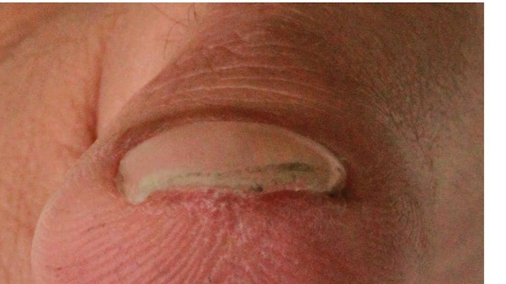 Polpastrello amputato che ricresce. Una volta che la lesione da amputazione è guarita completamente e il polpastrello è ricresciuto, l'arto può essere liberato dalla pellicola. A questo punto, anche l'unghia ricomincia a crescere.