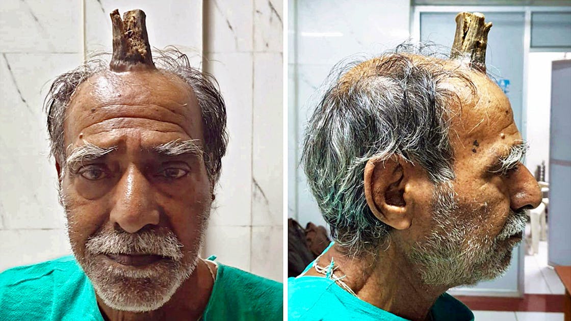 Seltene Erkrankung: Inder wächst zehn Zentimeter langes Horn auf dem