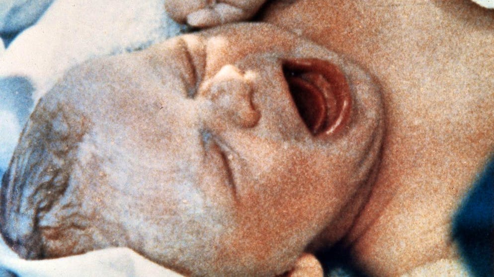 Louise Joy Brown kam am 25. Juli 1978 in Oldham, Grossbritannien, zur Welt. Sie ist der erste in vitro gezeugte Mensch, war also das erste Retortenbaby.