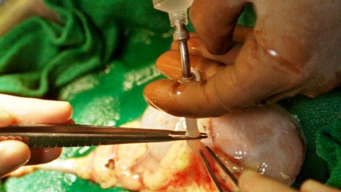 Diagnose von Leberzirrhose im Endstadium Diagnose von Leberzirrhose im Endstadium