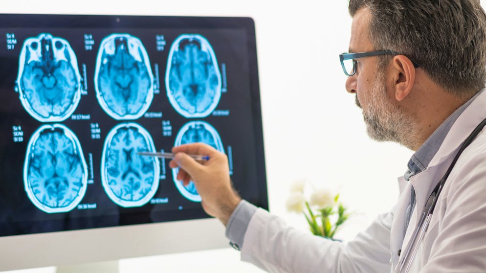 Das SARS-CoV-2-Virus kann auch im Gehirn Schaden anrichten. 