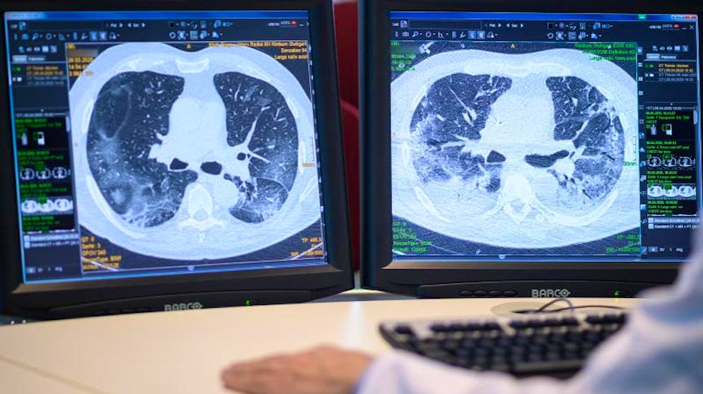 Auf zwei Monitoren sind am Klinikum Stuttgart Computertomographieaufnahmen der Lunge eines Covid-19-Patienten zu sehen. Foto: Sebastian Gollnow/dpa