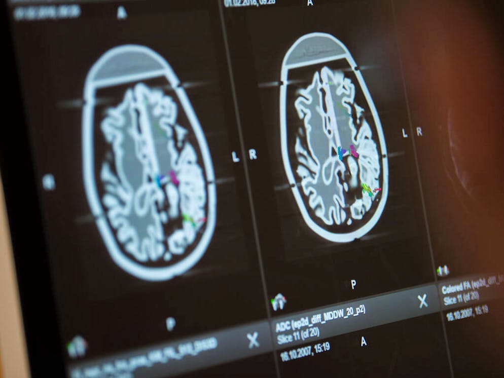 A camera man films a human brain's profile on a computer screen during the inaugural press conference at the clinic right of the river Isar in Munich, 1 February 2018. It is able to generate images from body parts similar to those of a CT scan. Neurosurgeons, vascular surgeons and urologists are going to have eight new surgery rooms to work in. Photo: Lino Mirgeler/dpa

Where: Munich, Bavaria, Germany
When: 01 Feb 2018
Credit: Lino Mirgeler/picture-alliance/Cover Images