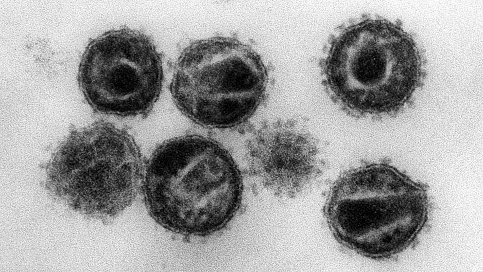 Le dépistage du sida a globalement fléchi de 22%, retardant le début des traitements dans la plupart des pays (archives).