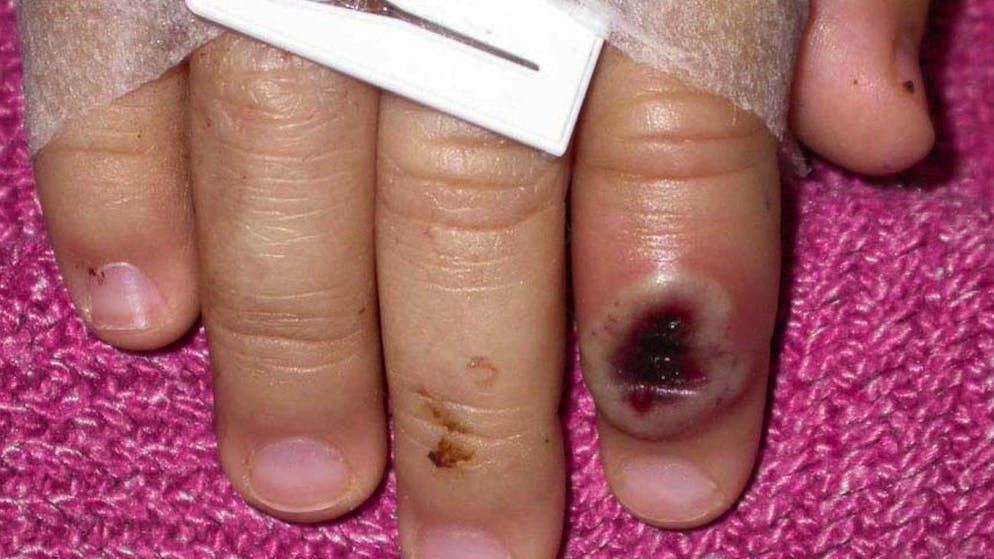 Fragen und Antworten. Was unternimmt die Schweiz gegen die Affenpocken?