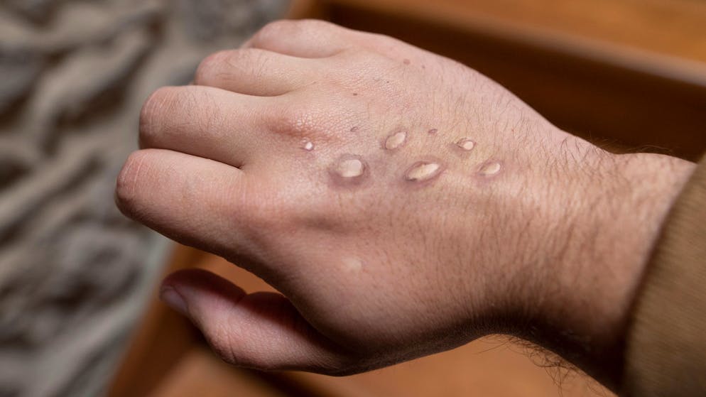 Monkey pox vesicles in a hand