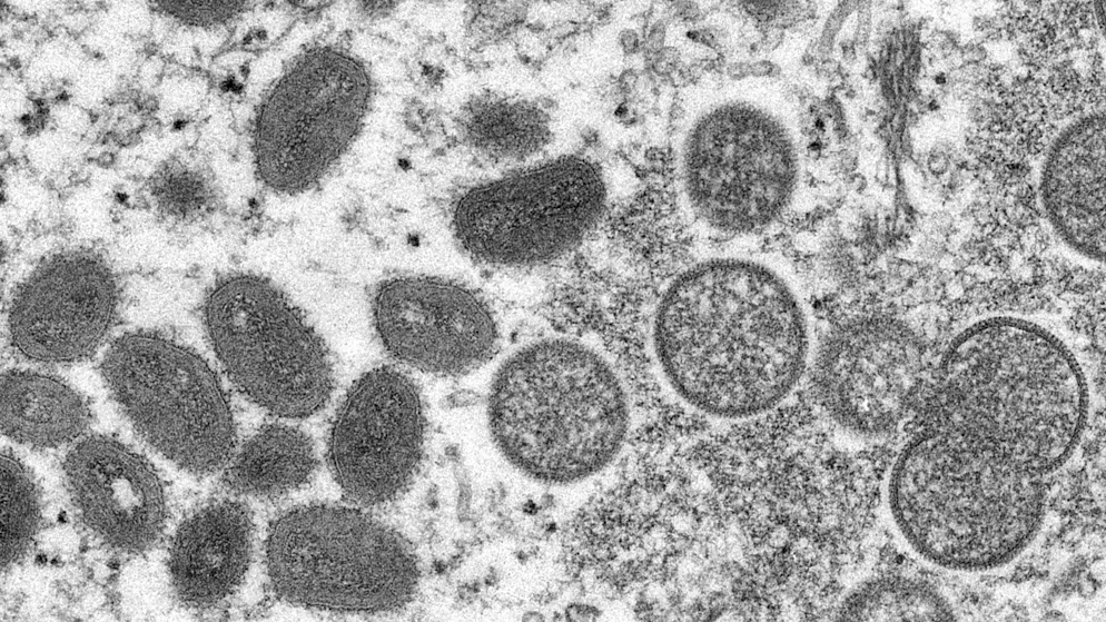 Bessere Überwachung. Affenpocken-Fälle sind jetzt meldepflichtig