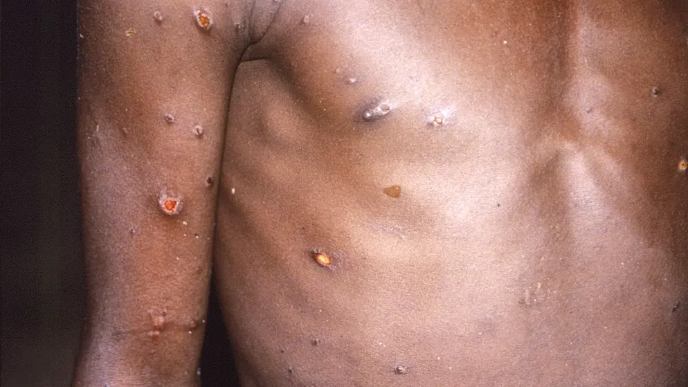 Dieses Bild von 1997 aus den USA zeigt für Affenpocken typische Hautwunden. Dieses Jahr tauchen in den USA und in Europa immer mehr Fälle auf. (CDC via AP)