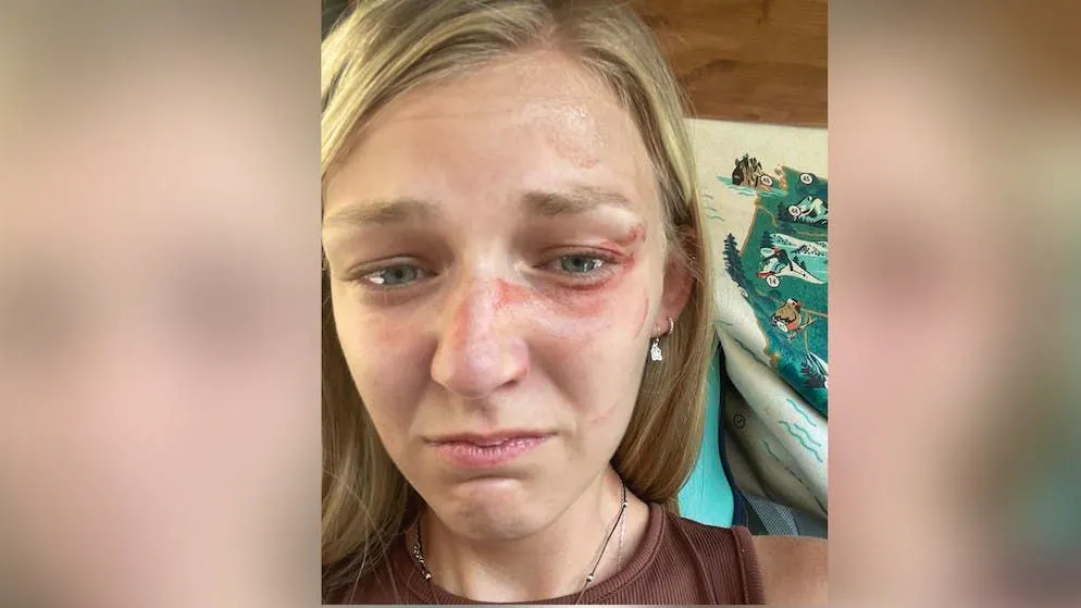 Lesioni ignorate. Una foto di Gabby Petito prima di essere uccisa mette nei guai la polizia