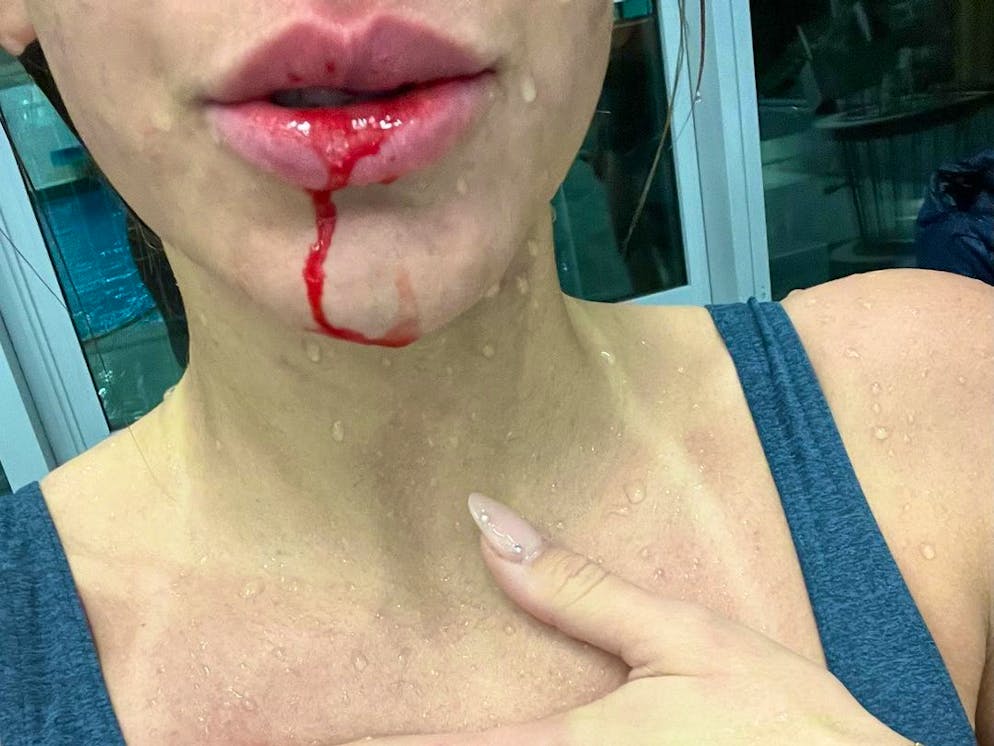 RTL-Turmspringen. Auf Instagram zeigt der Reality-Star weitere Verletzungen. Beim Training zog sie sich eine blutige Lippe ...