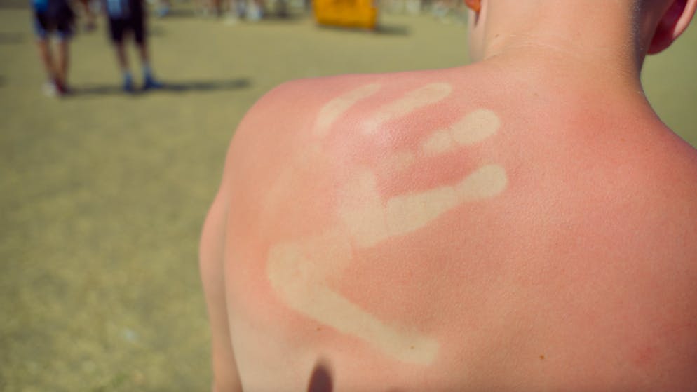 Hitze in Frauenfeld. Das nächste Mal mit Sonnencreme, gell?