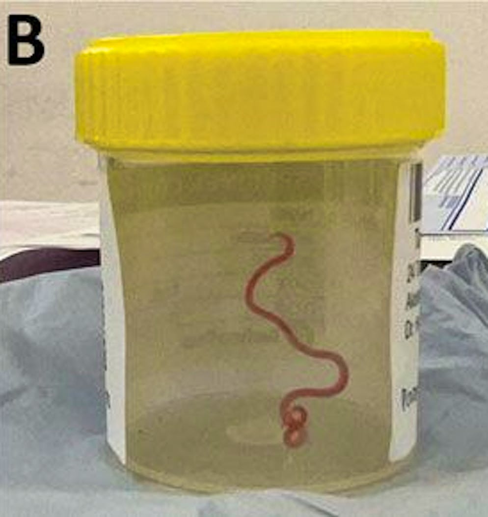 The roundworm, which was still alive, was sent to the experts: it was identified as 