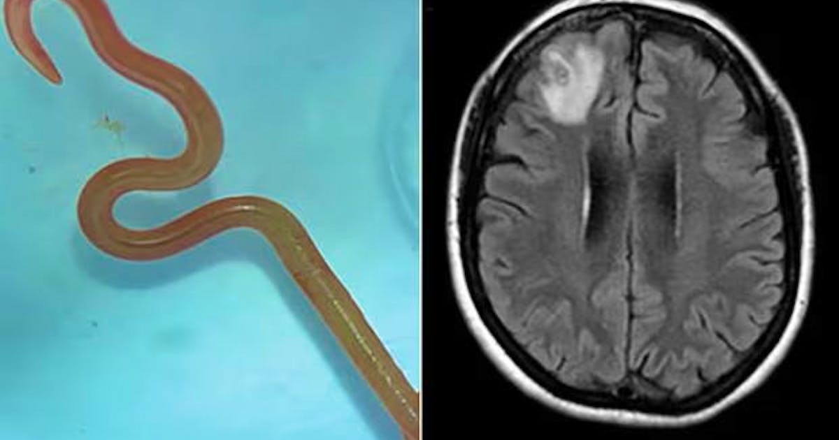 ‘It’s alive and wriggling’: an eight-centimeter worm removed from a patient’s brain