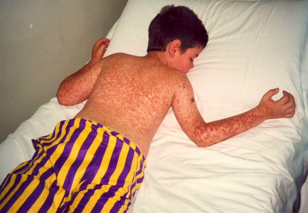 Un'immagine del 2002 mostra un bambino di 12 anni affetto da morbillo in un ospedale di Napoli, Italia. Solo pochi giovani sono adeguatamente protetti contro il morbillo. Solo uno su cinque è immunizzato.