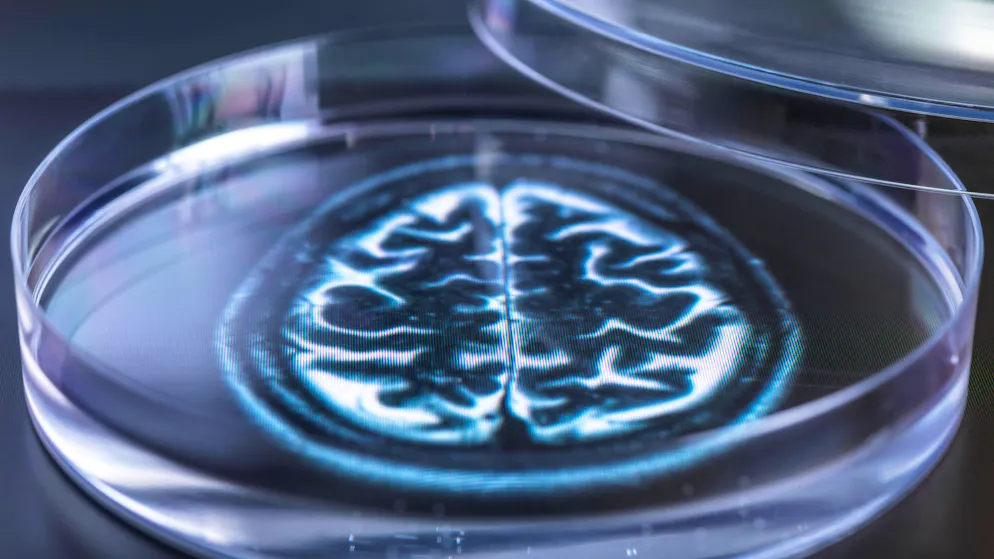 Anche sotto i 65 anni. Ecco i fattori che possono influenzare l'insorgere della demenza precoce