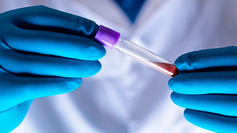 Neue Studie macht Hoffnung. Alzheimer soll Jahre vor Diagnose im Blut nachgewiesen werden können