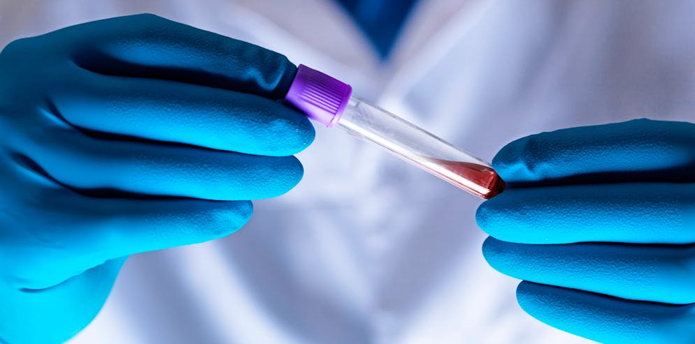 Eine neue Studie zeigt auf, dass Alzheimer anhand von sogenannten Protein-Biomarkern schon früh im Blut nachgewiesen werden könnte.