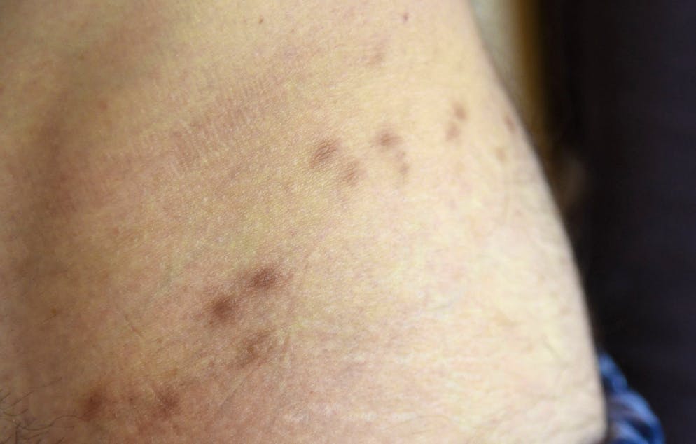 La scabbia è una malattia della pelle contagiosa e non mortale, causata dagli acari.