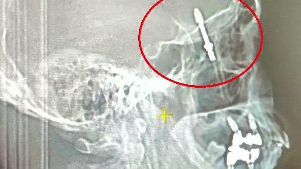 Da gehört die Schraube nicht hin: Ein Zahnarzt im türkischen Bursa hat einem Patienten versehentlich die Schraube eines Implantats ins Gehirn gebohrt.