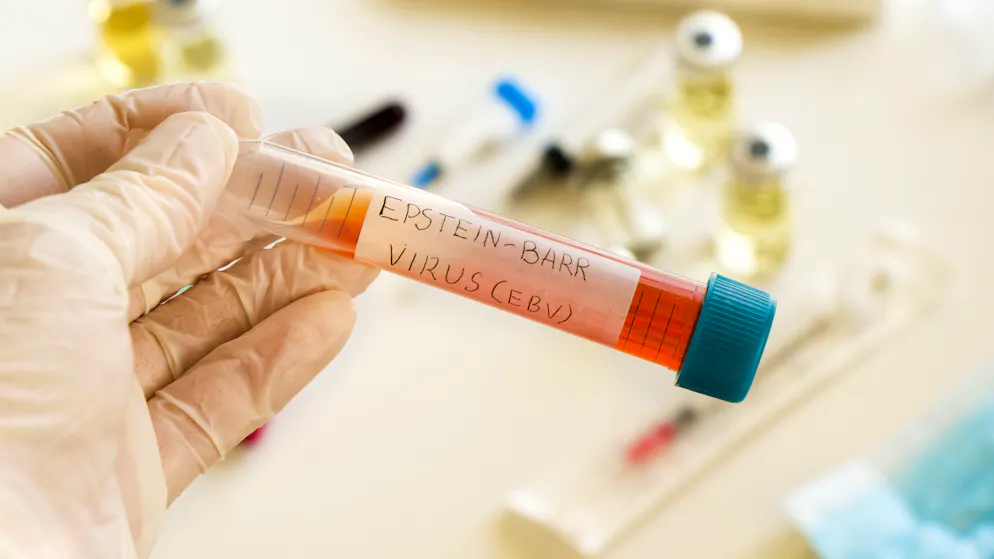 Bekannt ist Epstein-Barr-Virus vor allem als Erreger des Pfeifferschen Drüsenfiebers.
