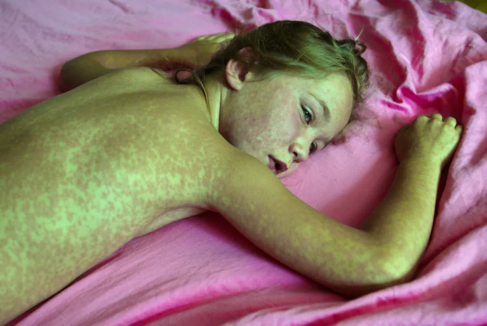 Nell'immagine illustrativa d'archivio una ragazzina di 7 anni con il morbillo.