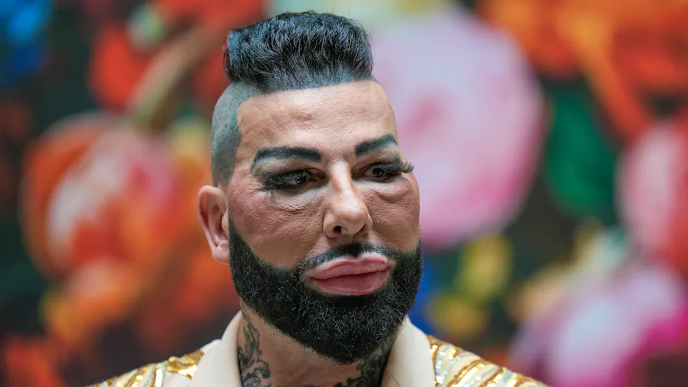 Dass Harald Glööckler sehr auf sein Aussehen achtet, ist nichts Neues. Doch nach dem Fadenlifting wirken die Wangen des Designers ziemlich geschwollen.