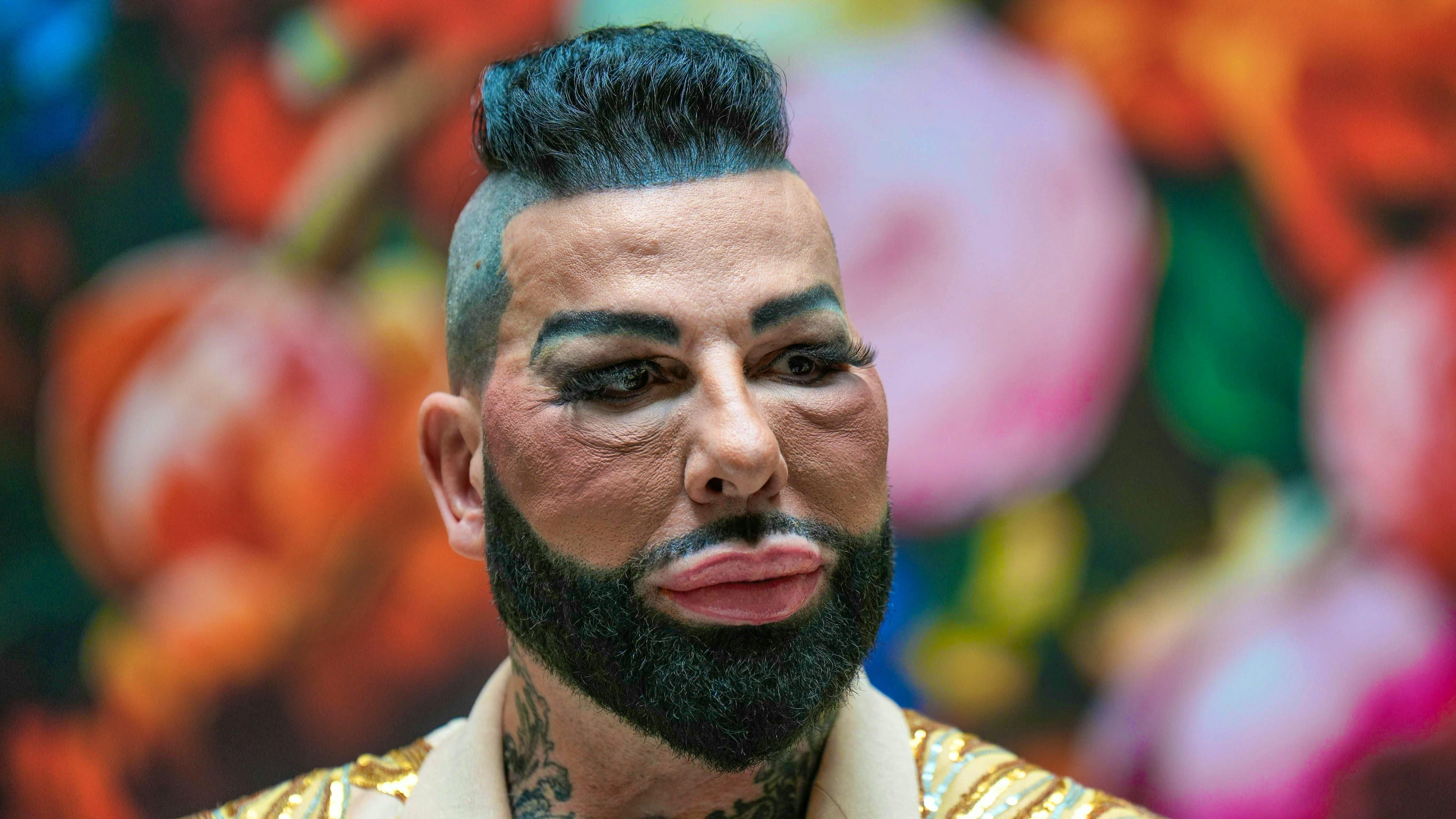 Hamster cheeks. Harald Glööckler has once again gone under the knife