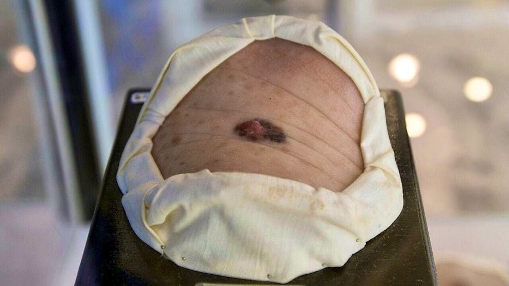 Resistance is widespread in targeted therapies against malignant melanoma. (archive image)