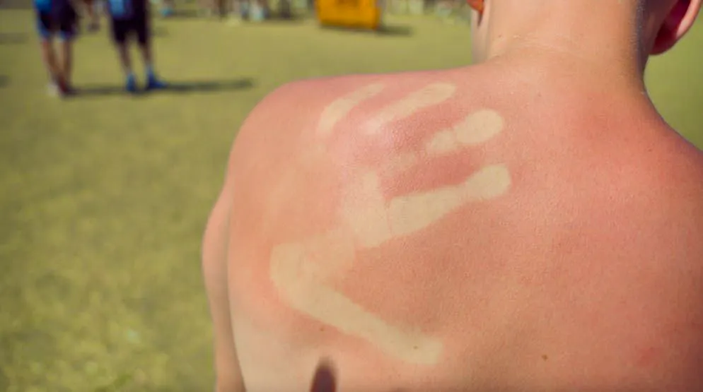 Heat in Frauenfeld. Next time with sunscreen, right?