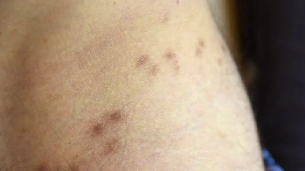 Itchy skin disease. Numerous calls from doctors and Zurich residents about scabies