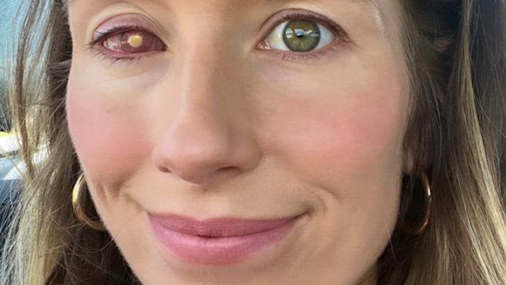 «82 Arztbesuche». Influencerin erblindet – weil sie mit Kontaktlinsen duscht