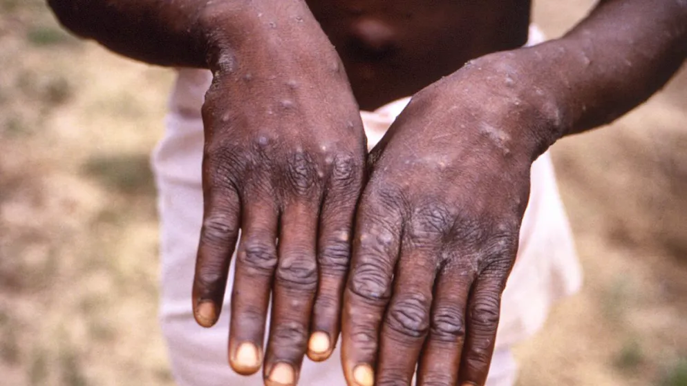 Les mains d'une personne infectée par le virus du mpox en RDC (archives).