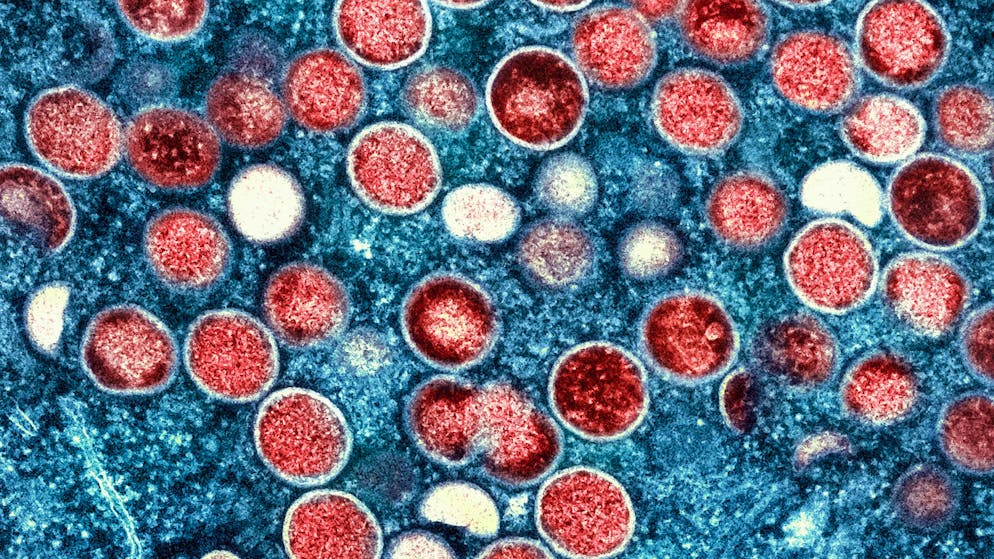 Mpox virus on the rise in Africa. The vaccine needed is in the wrong countries