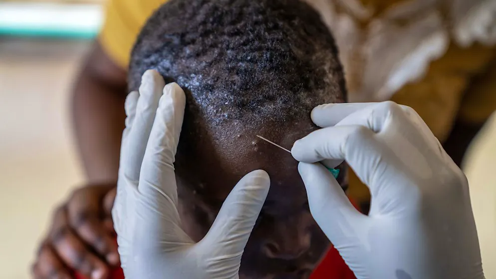 La variole du singe ou mpox est une maladie virale provoquant fièvre, douleurs musculaires et lésions cutanées (archives).