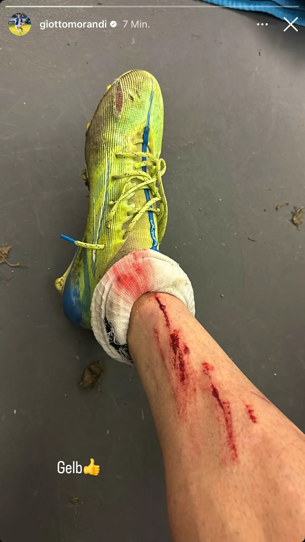 Giotto Morandi zeigt nach dem Cup-Spiel sein verwundetes Schienbein.