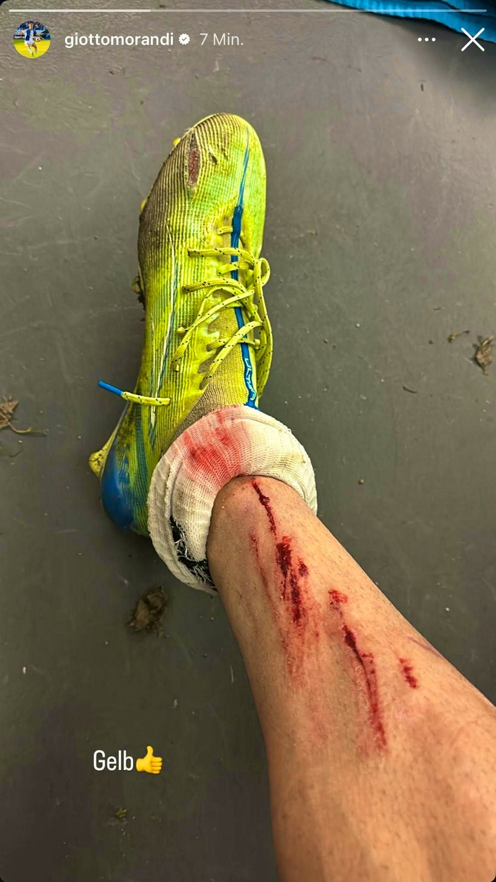 Giotto Morandi shows his injured shin after the Cup match.