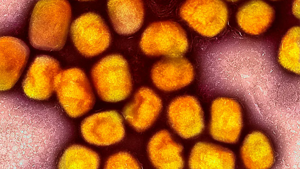 The new variant of the Mpox virus has been detected for the second time in Germany. Four members of a family in the Rheinisch-Bergisch district near Cologne have fallen ill.