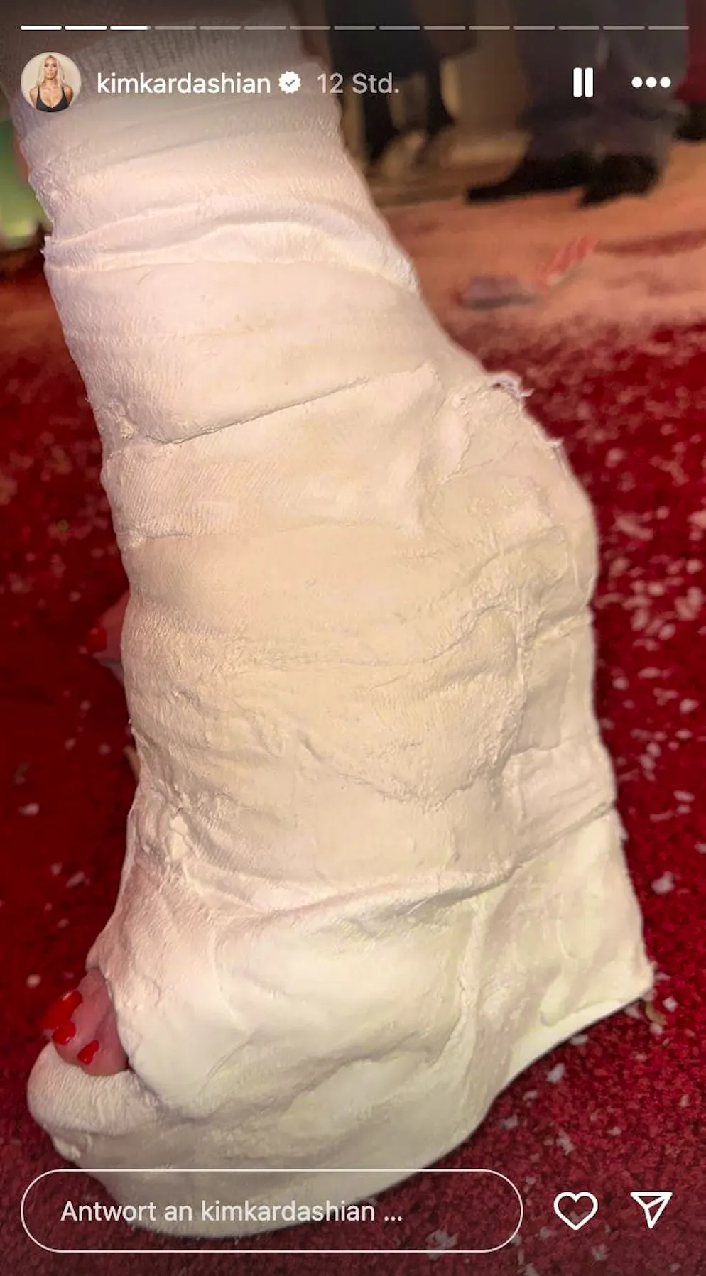Kim Kardashian has broken her foot. She shows off her high-heel cast in an Instagram story.