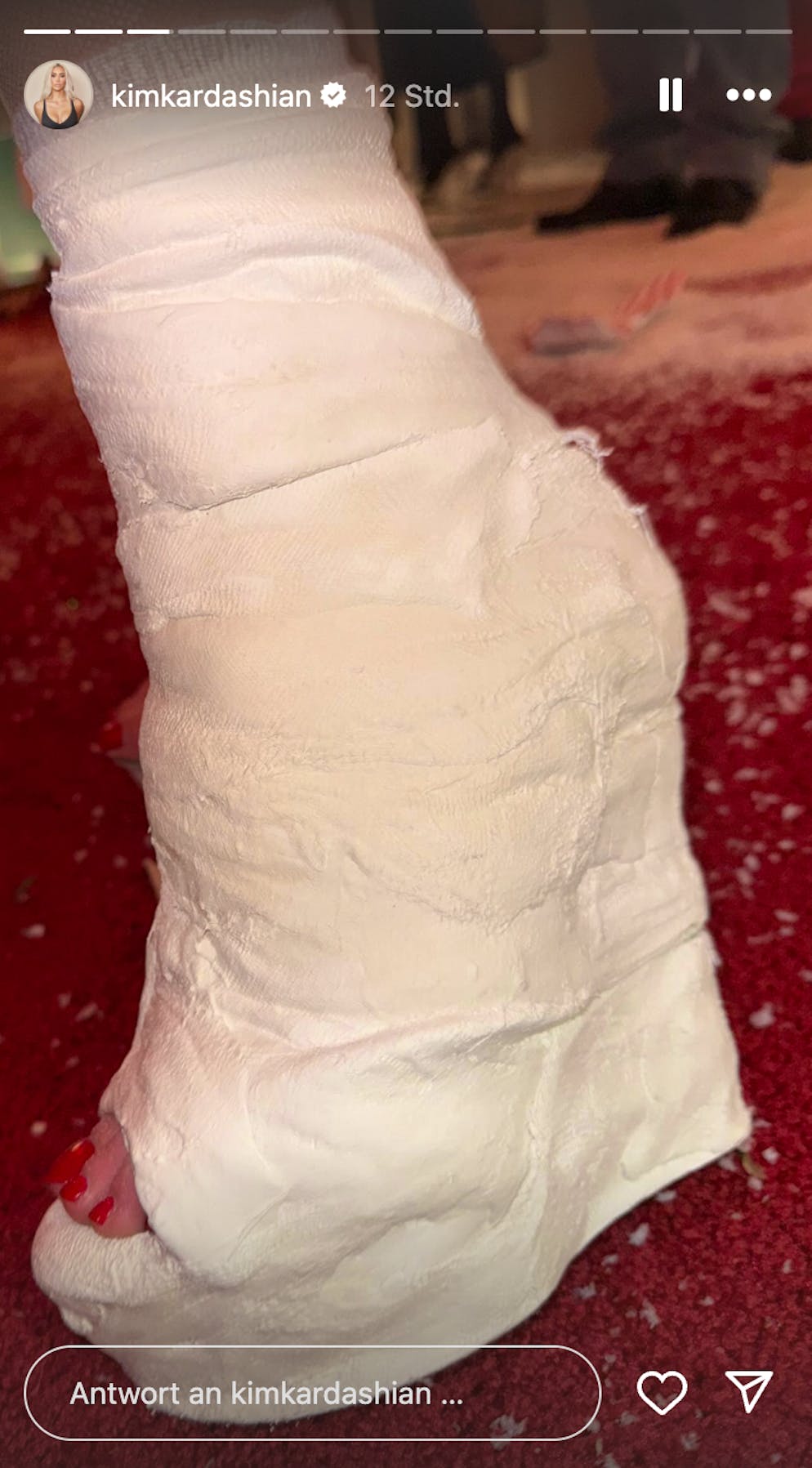 Kim Kardashian hat sich den Fuss gebrochen. In einer Instagram-Story präsentiert sie ihren High-Heel-Gips.